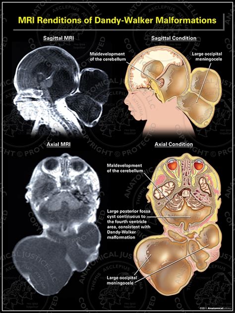 MRI Renditions of Dandy-Walker Malformations