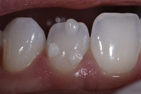 Non-invasive resin bonding to change shape of lateral incisor