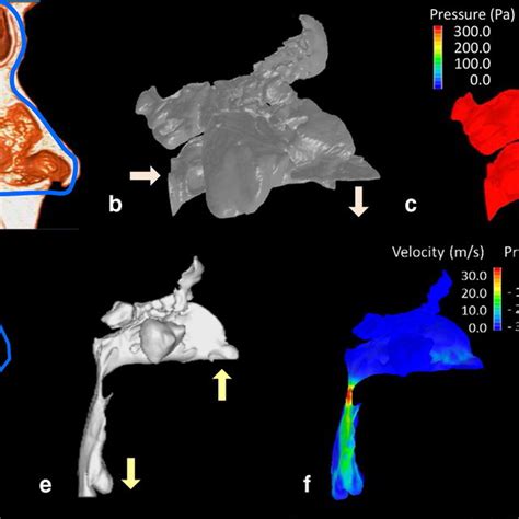 Evaluation Of The Nasal Airway Model And Upper Airway Pressures During