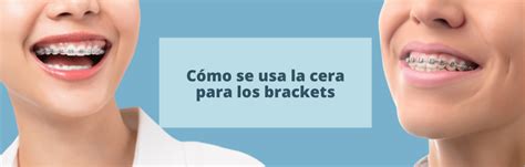 Cómo se usa la cera para los brackets Clínica Montaño Herrera