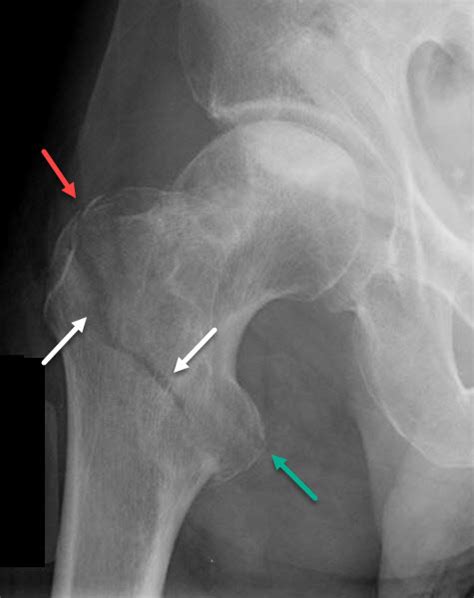 Greater Trochanter Avulsion Fracture