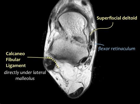 MRI ankle ligaments axial 6 Diagram | Quizlet