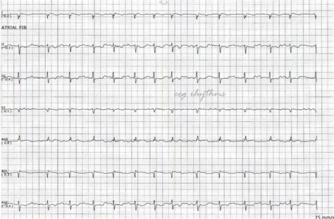 ECG Rhythms ECG Practice 4704 | Hot Sex Picture