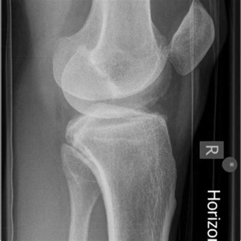 Lateral Radiograph Of Knee Showing Dislocated Patella Figure 2 Ap