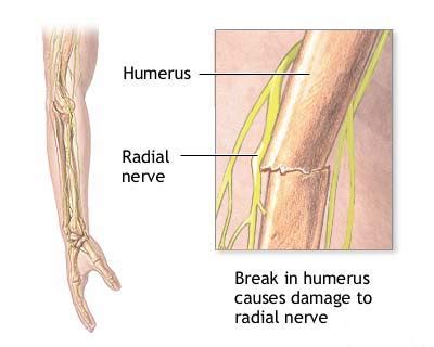 Injury of Radial nerve: Cause, Symptoms, Treatment, Exercise