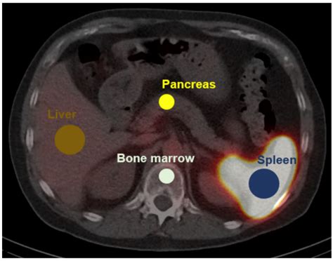 Diagnostics Free Full Text Detection Of Splenic Tissue Using 99mtc