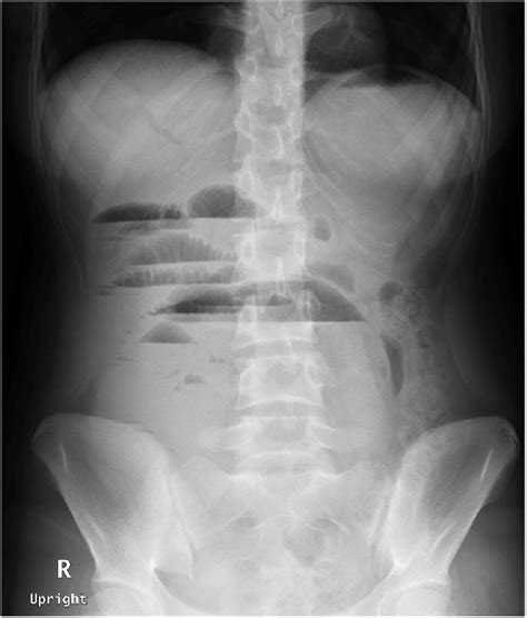 Case 2. Plain x-ray of the adhesive bowel obstruction. | Download ...