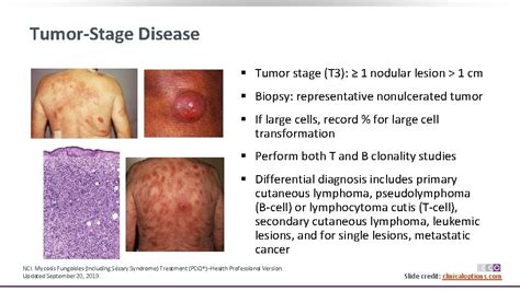 New Systemic Therapies For Mycosis Fungoides And Szary