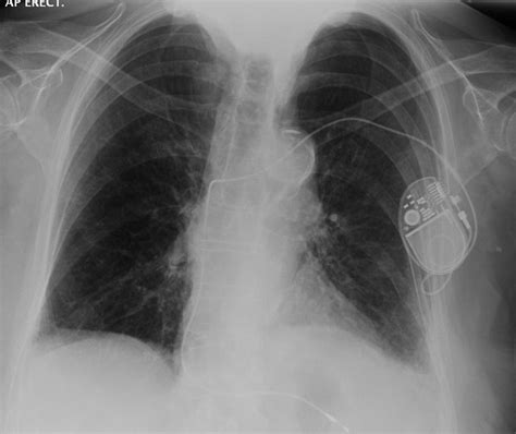 Implantable Cardioverter Defibrillator X Ray