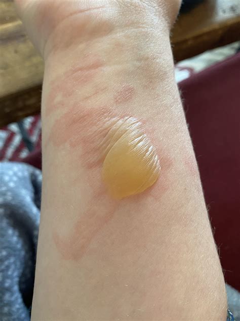 Bleb Burn