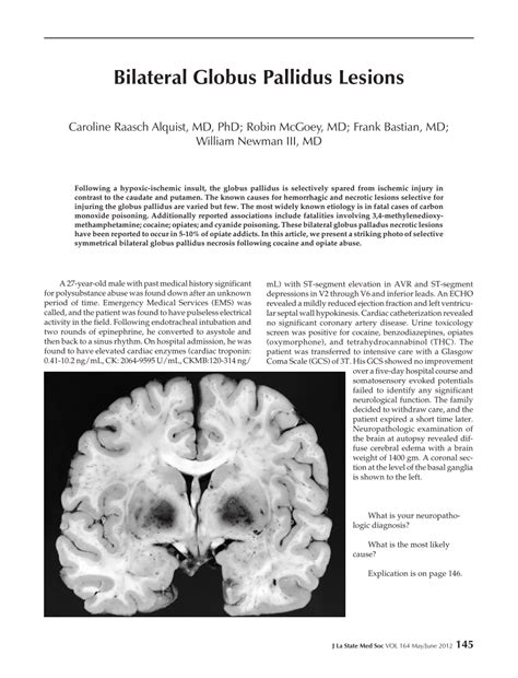 Pdf Bilateral Globus Pallidus Lesions