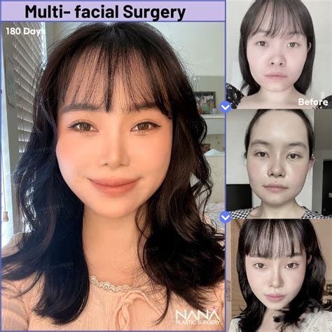 Complete Face Makeover At Korean Plastic Surgery Hospital Nana