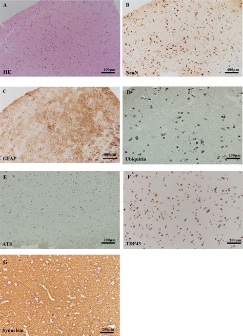 Histopathological Findings Mild Neuronal Loss Was Evident In A Hande