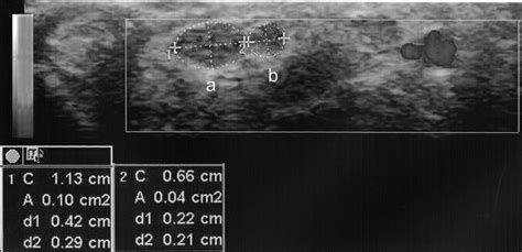 Sonographic Assessment Of A Bifid Median Nerve And Median Artery In