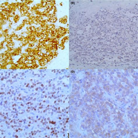 A Positivity Of Catenin In The Tumor Cells B Ecadherin Is Diffusely