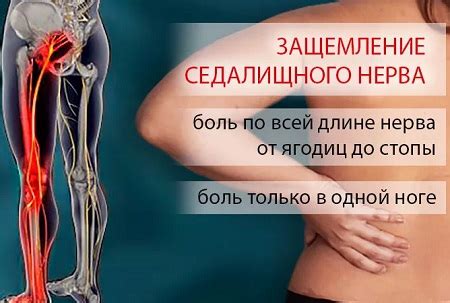 Массаж при защемлении нерва в пояснице | Что такое защемление нерва?