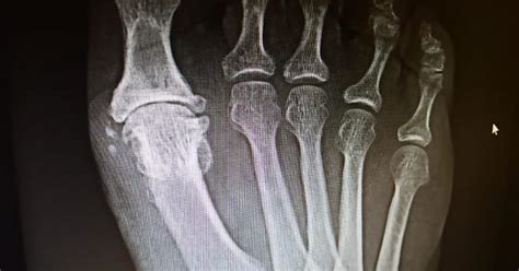 Xray Of Mom S Foot Before Surgery Hard To Tell What Needed Fixing Severe Arthritis Hallux