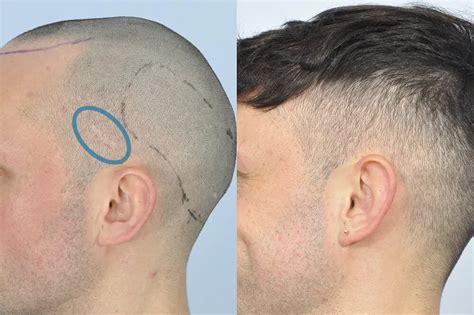 Treatment Of Scars Hair Transplant Clinic Uk