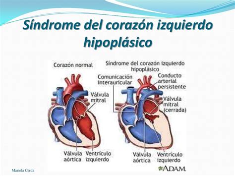 Cardiopatías Cianóticas