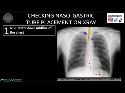 Chest Tube Placement X Ray