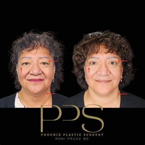 Phoenix Plastic Surgery | Face Photos | Phoenix Scottsdale AZ