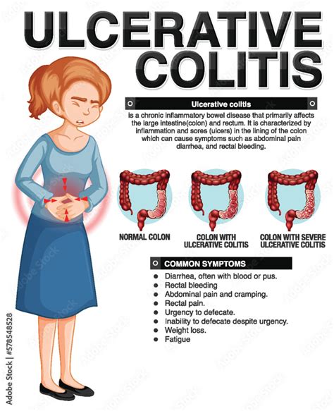 Ulcerative Colitis Symptoms Infographic Stock Vector Adobe Stock