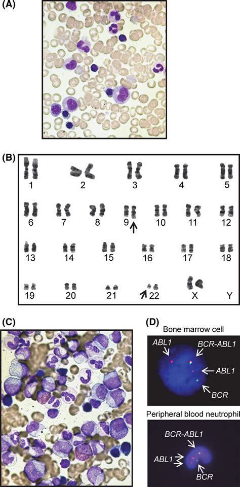 Incidentallydetected T 9 22 Q34 Q11 BCRABL1 Positive Clone