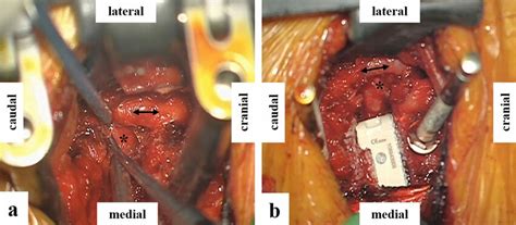 Intraoperative Images A Vertebral Artery Double Arrow Mobilization