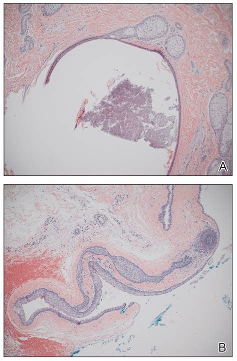 Multiple Subcutaneous Dermoid Cysts Mdedge Dermatology