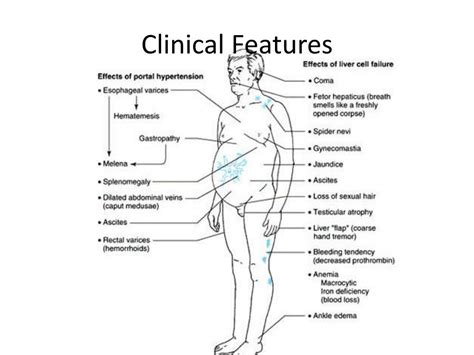 Ppt Liver Cirrhosis And Its Complications Powerpoint Presentation Free Download Id 5152529