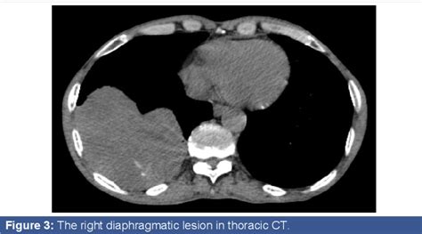 PDF Soliter Fibrous Tumor Of Diaphragm In A Patient With Larynx