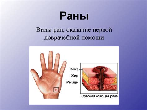 Раны. Виды ран, оказание первой доврачебной помощи - online presentation