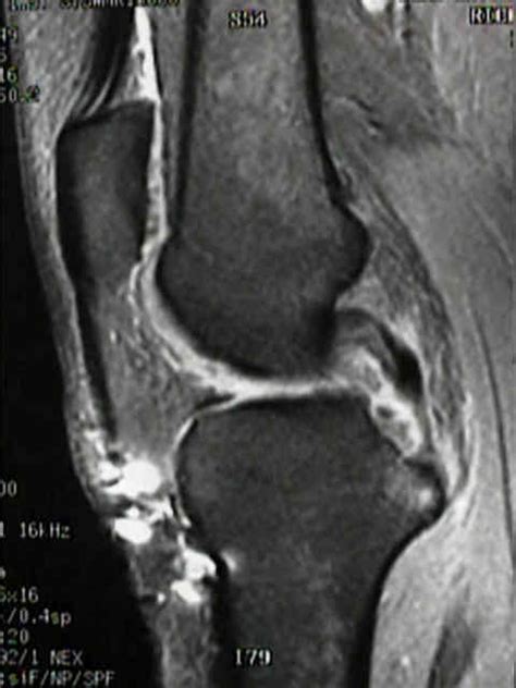 Mri Of Pcl Pcl Tears Wheeless Textbook Of Orthopaedics