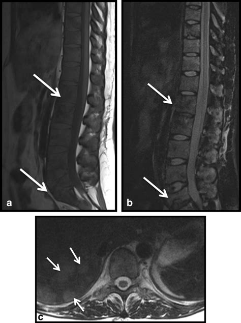 Sclerotic Lesions Of The Spine Mri Assessment Mugera