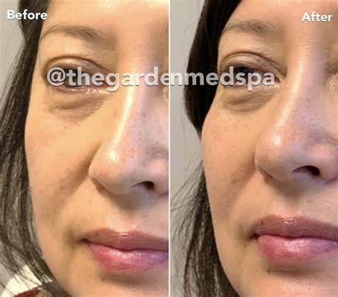 Dermal Fillers Before And After Pictures Client Tampa Bay North