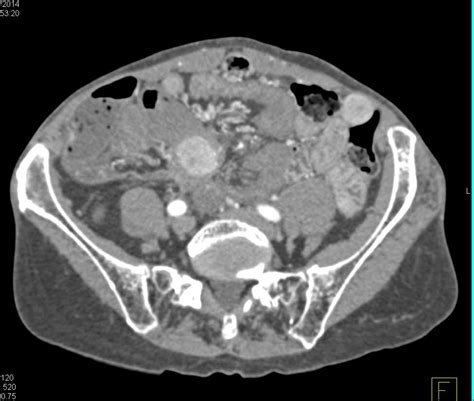 Metastatic Carcinoid Tumor To The Liver And Bowel And Mesentery Small