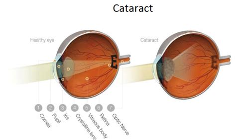 Facts About Cataract Faq Himachal Eye Hospital