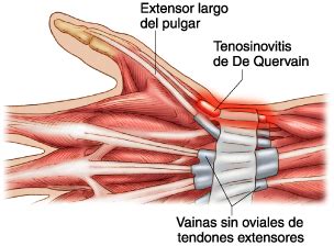 Tenosinovitis De Quervain