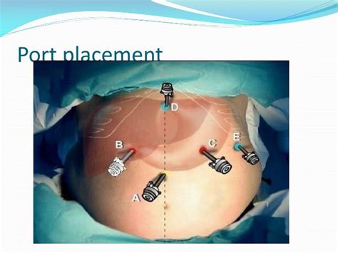 Ppt Laparoscopic Sleeve Gastrectomy Powerpoint Presentation Id 3097830