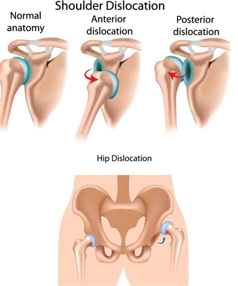 Joint Dislocation Chiropractor: Sciatica Clinic