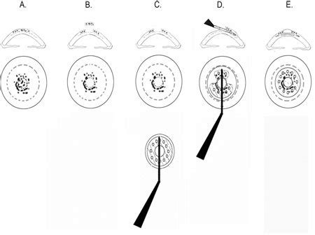 Foldable artificial cornea offers alternative to corneal transplantation