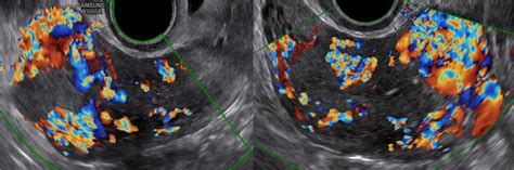 The Color Doppler Transvaginal Ultrasound On The Sagittal And