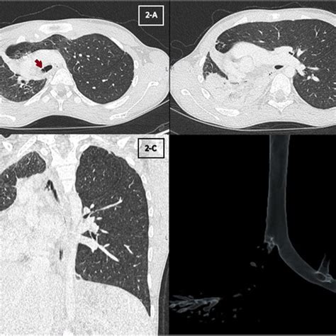 A Chest Computed Tomography Transverse Section Red Arrow Shows Download Scientific Diagram