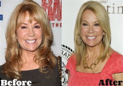 Kathie Lee Gifford before and after plastic surgery 03 – Celebrity plastic surgery online