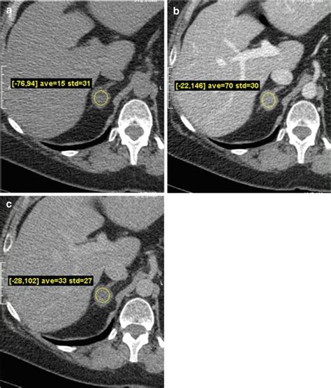 Adrenal Gland X Ray