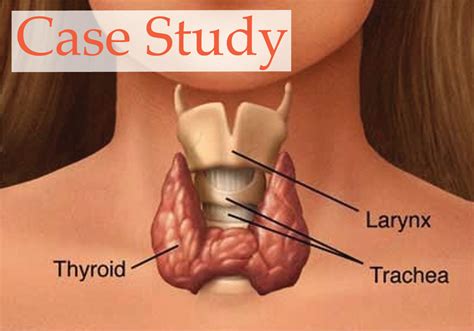 Case Study: Thyroid Nodules - Josh Gitalis