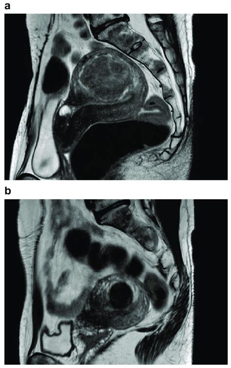 T Weighted Images Of Pelvic Mri Sagittal Plane A Before Surgery