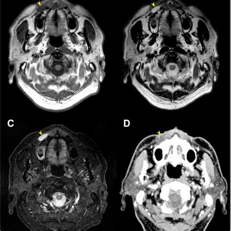 Pre Operative Mri And Cect A C Axial Views On Mri A T1 Weighted Download Scientific Diagram