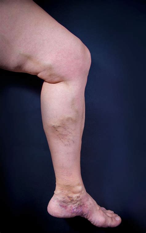 Chronic Venous Insufficiency Treated At Scmsc