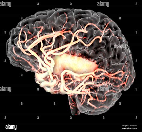 Les Accidents Vasculaires C R Braux Trois Dimensions Couleur